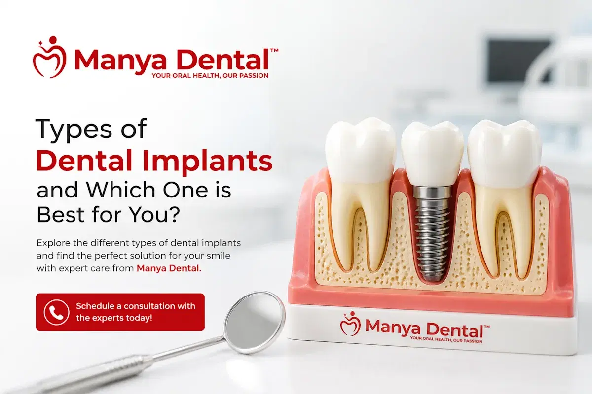 Types of Dental Implants and Which One is Best for You